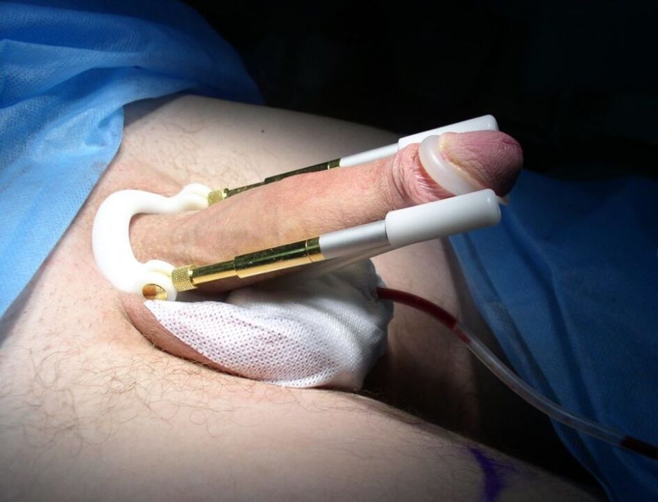 Usar un extensor despois da cirurxía