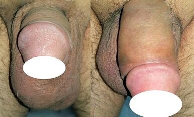 Foto antes e despois de aumentar o pene