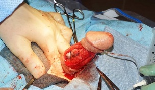 Cirurxía de ampliación do pene