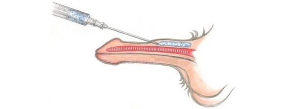 Lipofilling, que permite aumentar o tamaño do falo